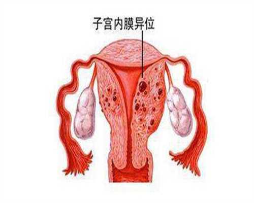 子宫肌瘤：了解其典型症状及其健康影响